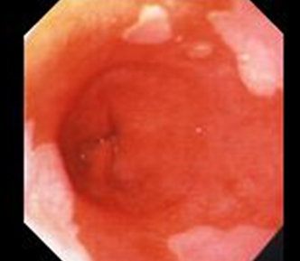 barett-gastroskopisi2