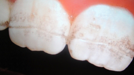 οδοντική βλάβη στήν κοιλιοκάκης