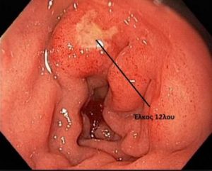 Έλκος βολβού 12λου