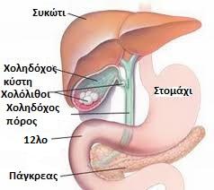 Πέτρες στη χολή