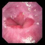 Γαστροοισοφαγική παλινδρομική νόσος