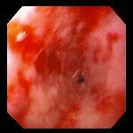 Γαστροοισοφαγική παλινδρομική νόσος