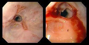 Γαστροοισοφαγική παλινδρομική νόσος