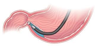 Η Γαστροπάρεση και πως αντιμετωπίζεται