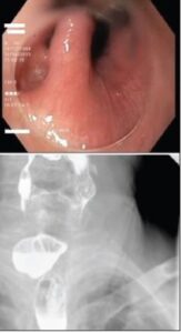 Εκκόλπωμα Zenker