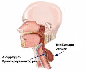 Εκκόλπωμα Zenker