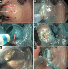 Εκκόλπωμα Zenker