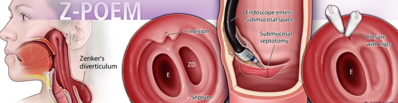 εκκόλπωμα Zenker και πως αντιμετωπίζεται Εκκόλπωμα Zenker