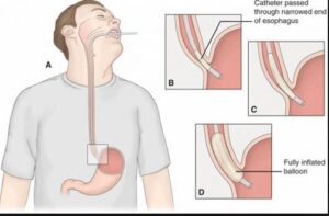 Αχαλασία με δυο λόγια